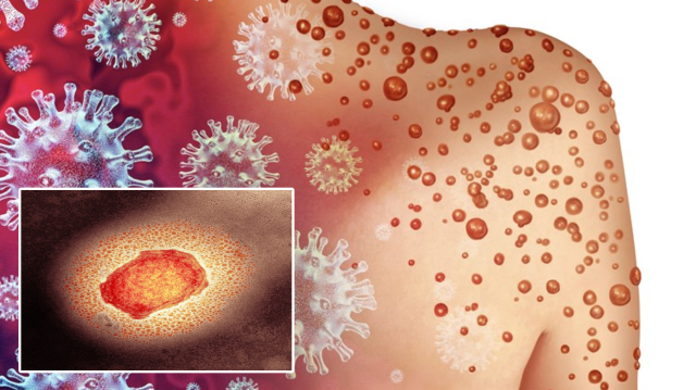 570 kişi maymun çiçeğinden öldü: Kongo’da süratle yayılıyor