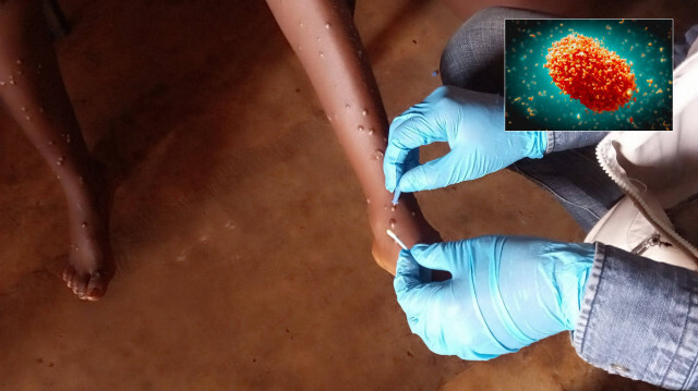 DSÖ, Mpox Virüsü Nedeniyle Acil Durum İlan Etti