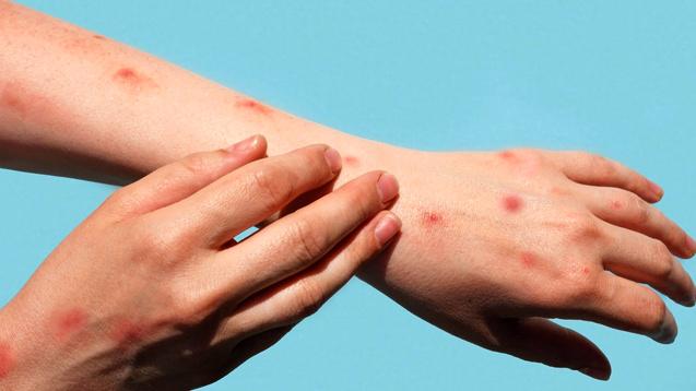 Maymun Çiçeği Virüsü: Yeni Salgın Tehdidi ve Belirtileri