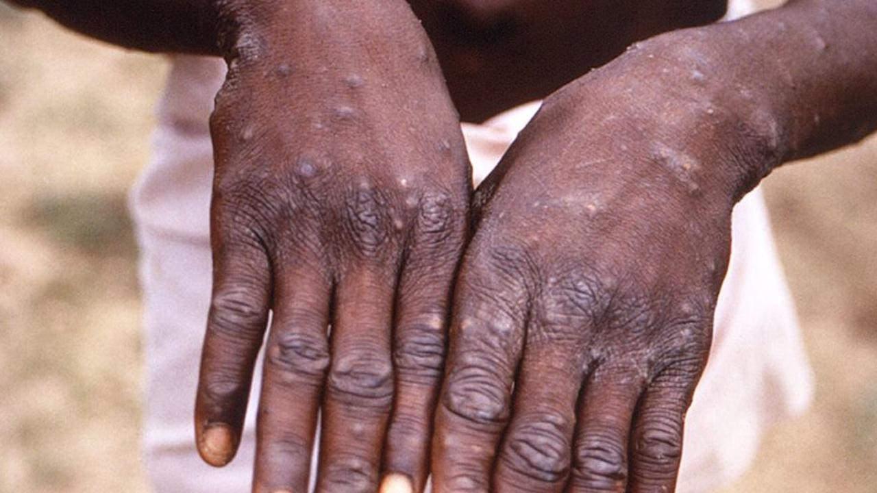 Sabri Ülker Vakfı, Maymun Çiçeği ile ilgili merak edilen soruları yanıtladı