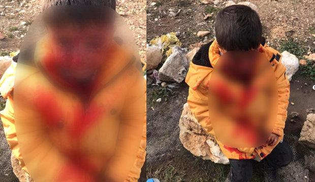 Adıyaman'da küçük Ahmet'i ısıran köpek kuduz çıktı