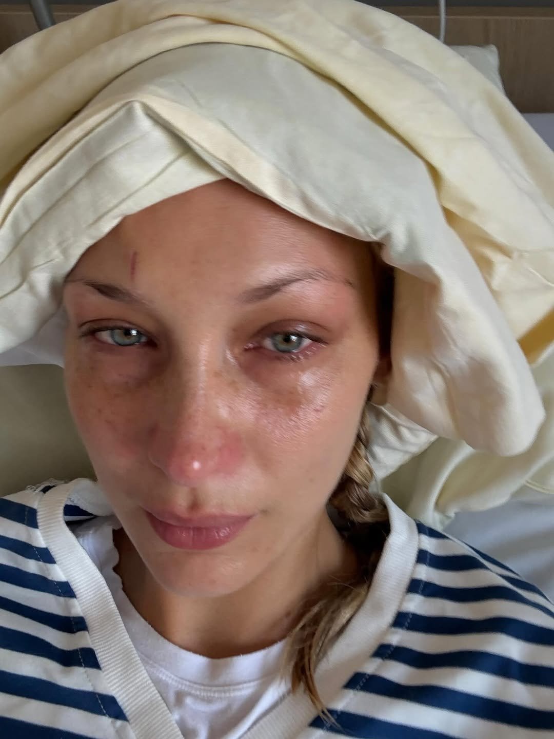 Bella Hadid Lyme hastalığıyla gayretini paylaştı
